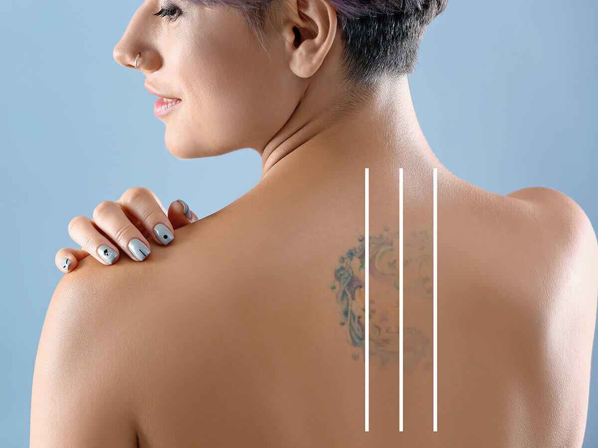 Analytical Chemistry and the Hidden Risks of Laser Tattoo Removal -  PreScouter - Custom Intelligence from a Global Network of Experts